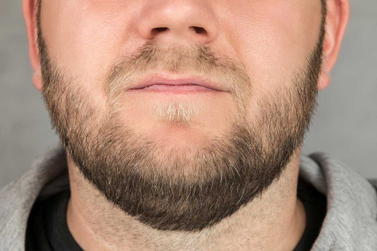 DHI Beard Transplantation